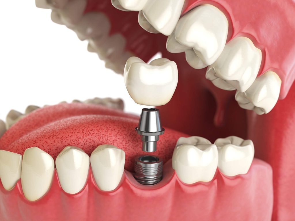 выпадения зубных имплантов